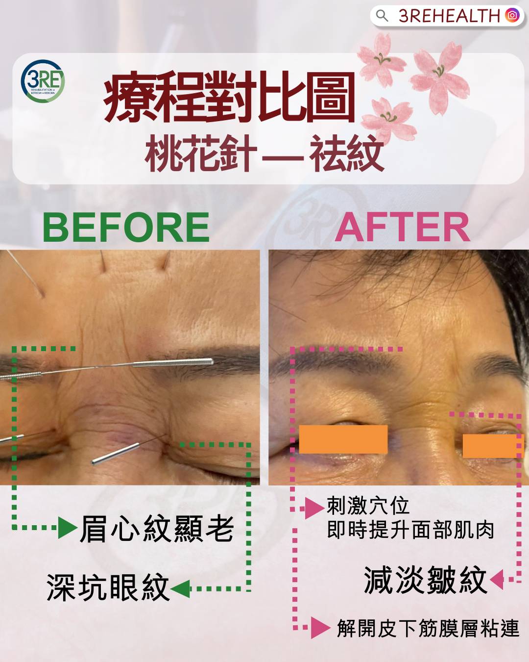 3RE 中醫療程—桃花針 — 四十年註冊中醫主理