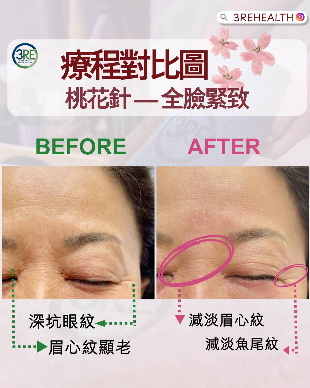 3RE 中醫療程—桃花針 — 四十年註冊中醫主理