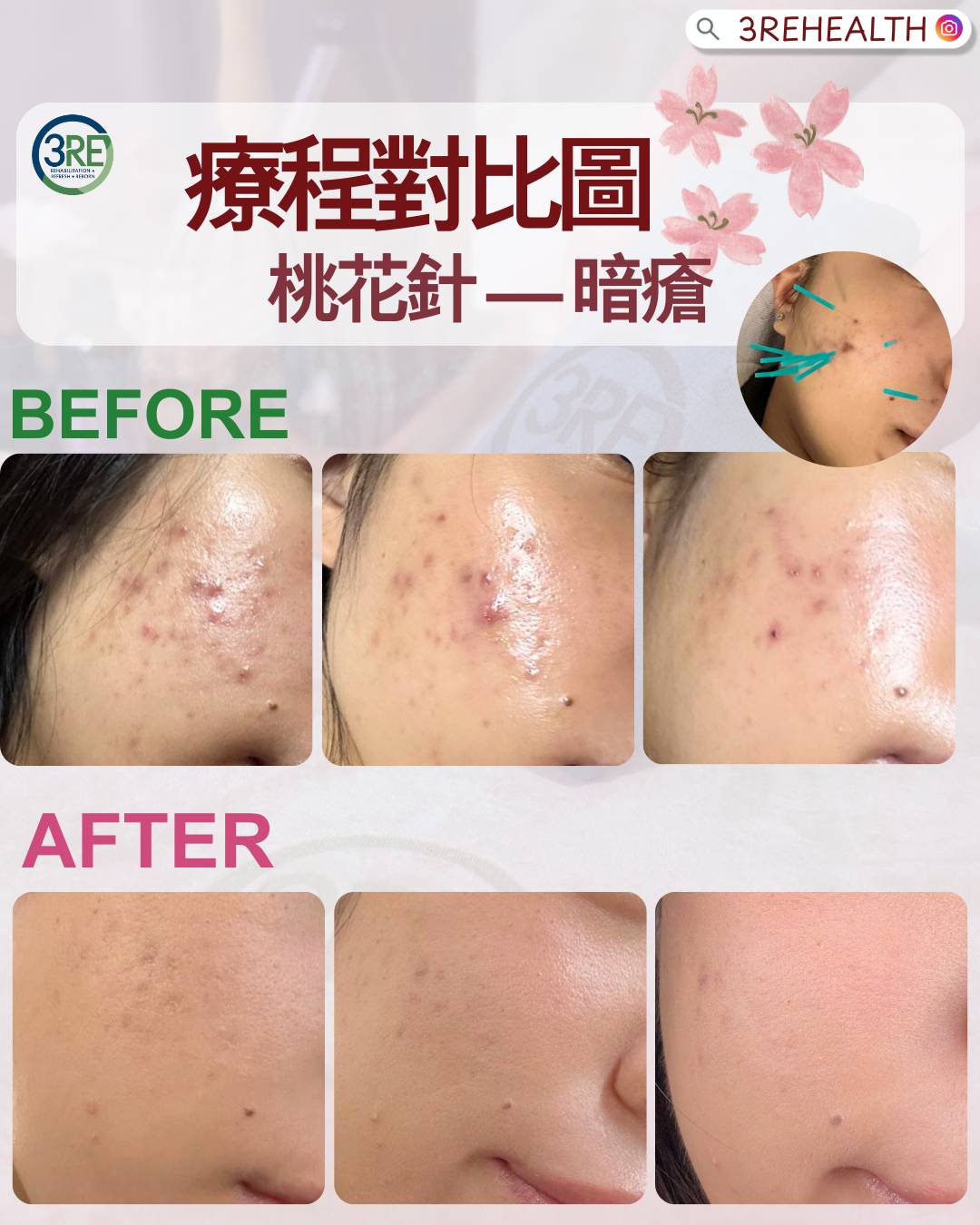 3RE 中醫療程—桃花針 — 四十年註冊中醫主理