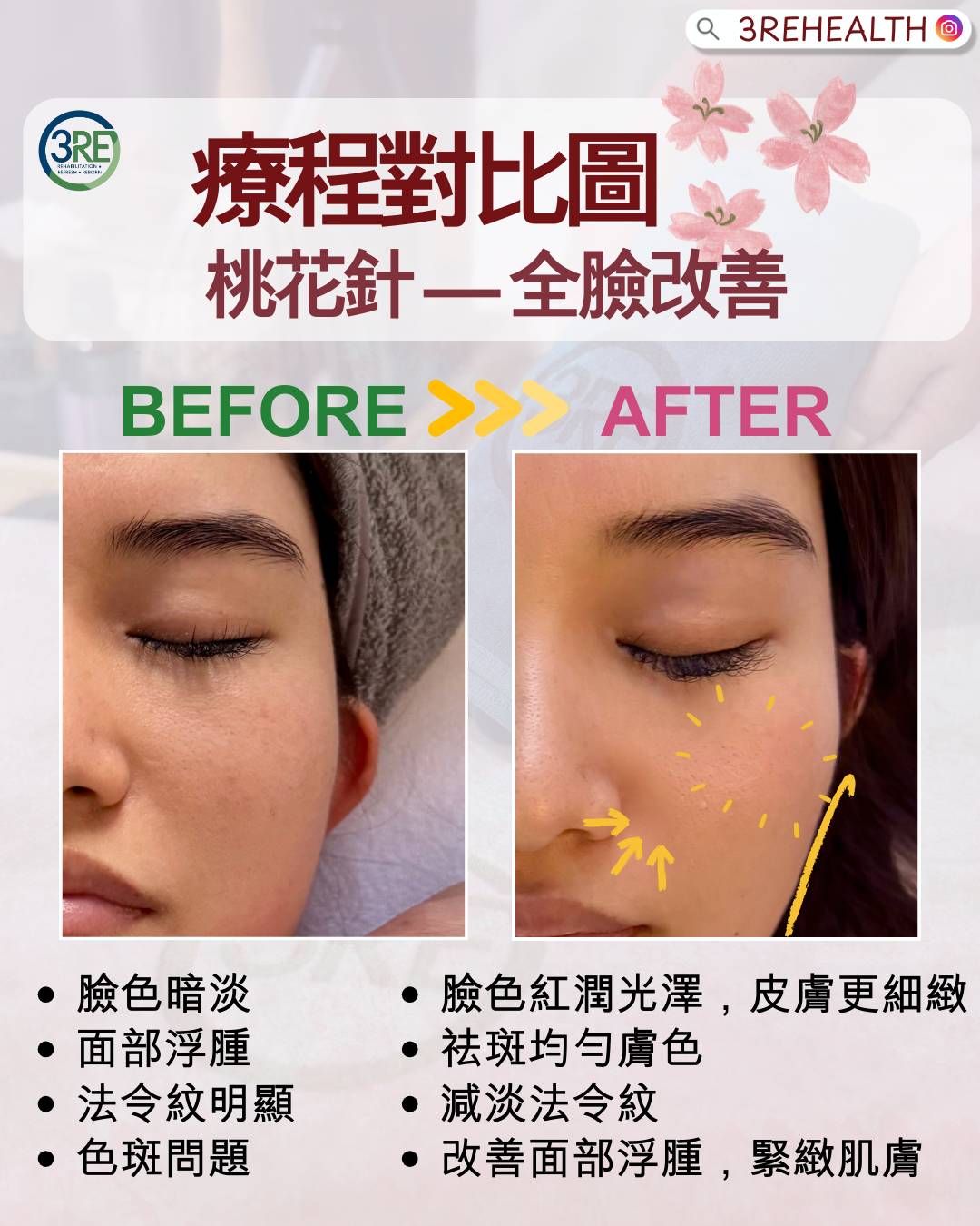 3RE 中醫療程—桃花針 — 四十年註冊中醫主理