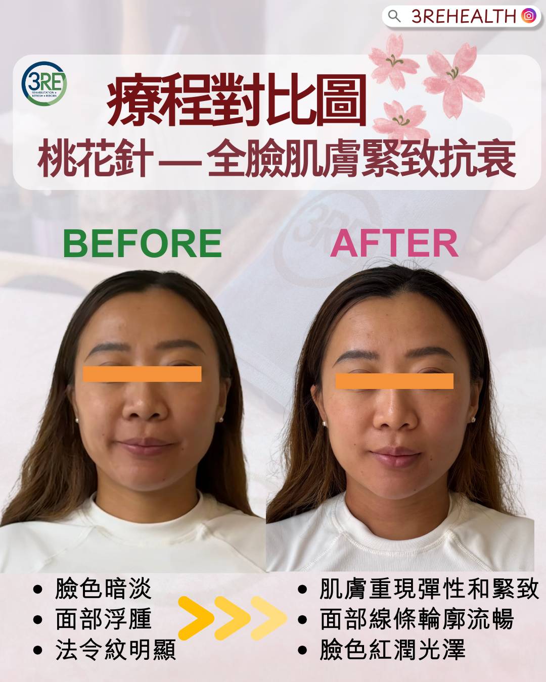 3RE 中醫療程—桃花針 — 四十年註冊中醫主理